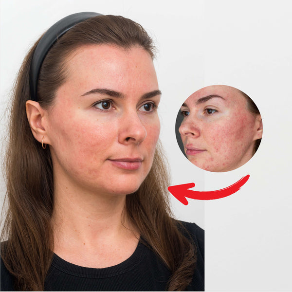 Rosacea försvann