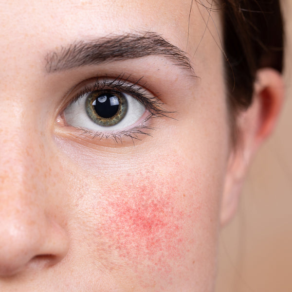 What is rosacea and how do you treat it ?